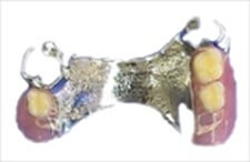 金属PD義歯